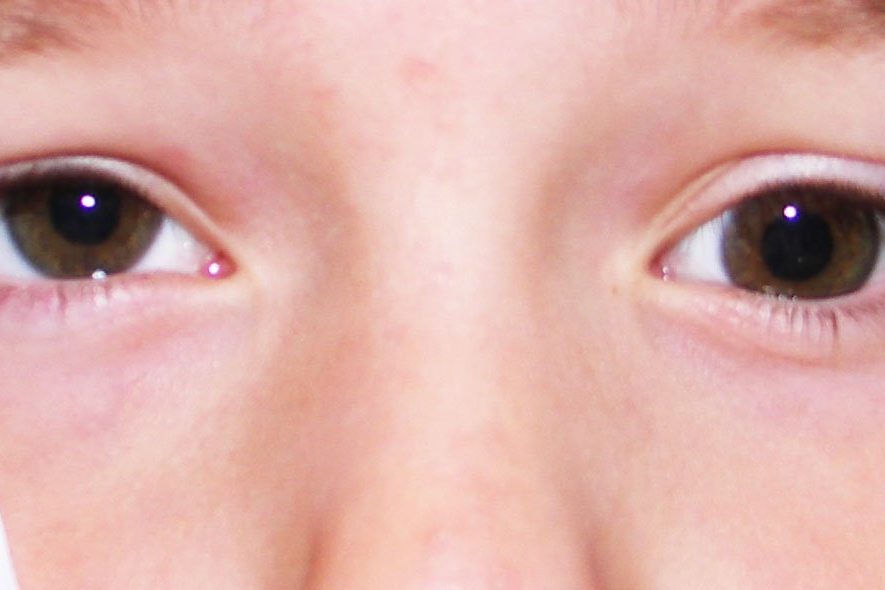 Estrabismo pediátrico Estrabismo pediátrico