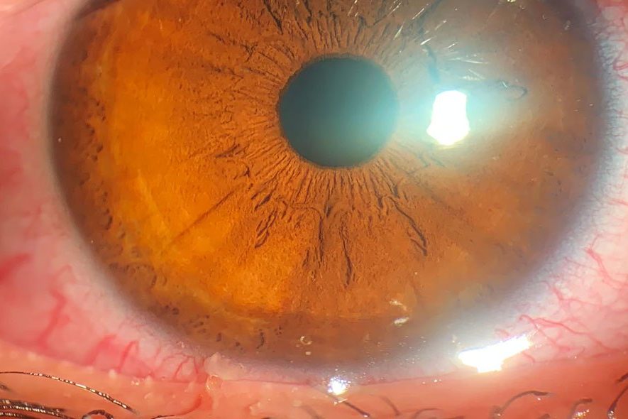 conjuntivite no olho conjuntivite no olho