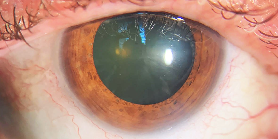 Dilatação Pupilar Dilatação Pupilar