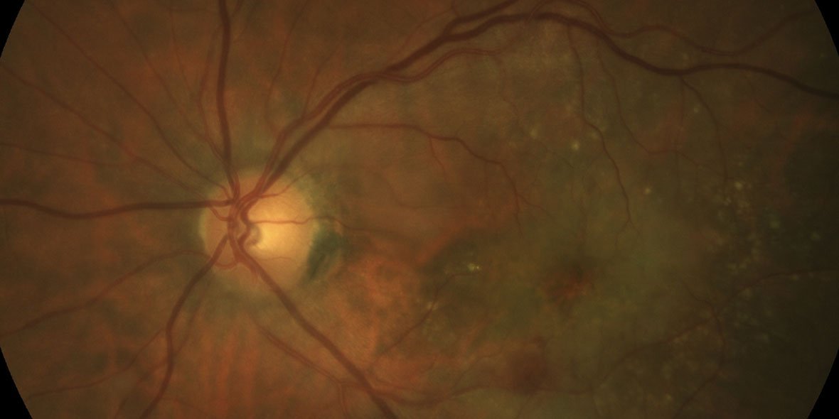 Degenerescência Macular da Idade