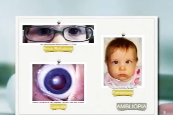 Oftalmologia pediatrica estrabismo - porto canal parte 2