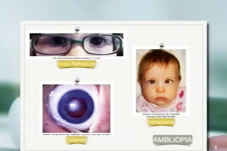 Oftalmologia pediatrica estrabismo - porto canal parte 2